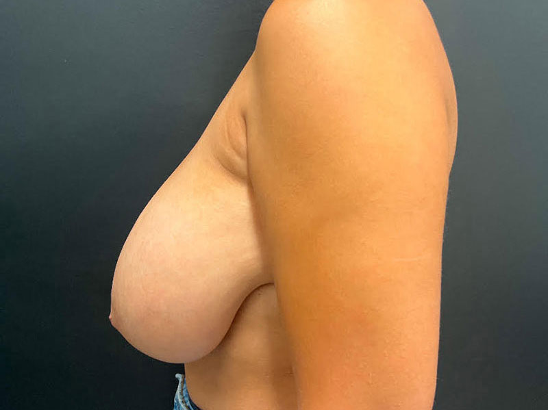 Breast Reduction Before & After Image