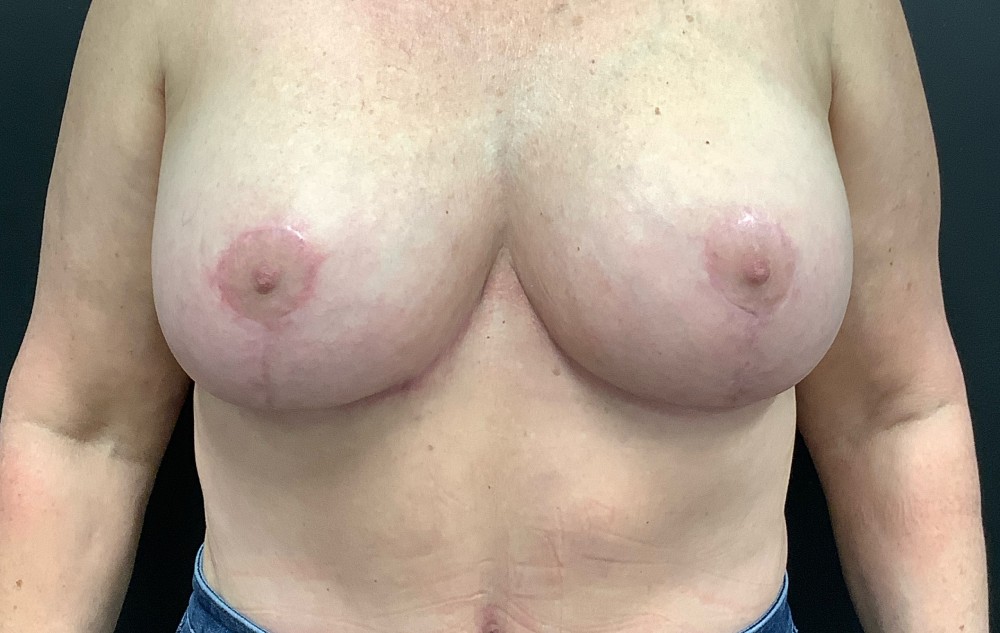 Breast Reduction Before & After Image
