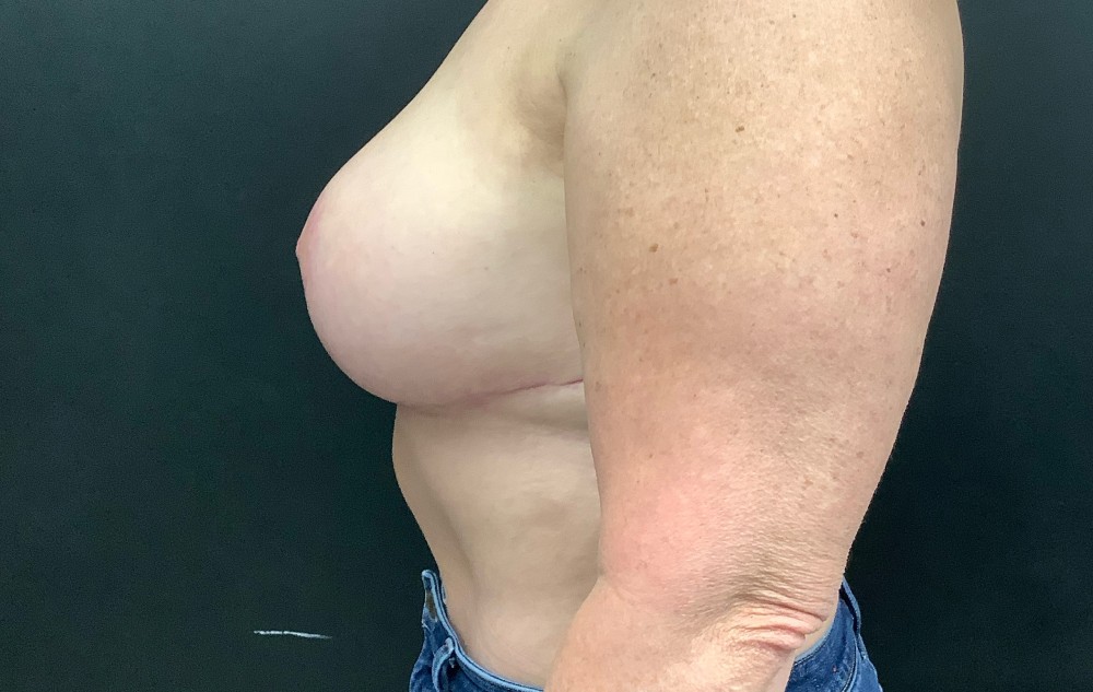 Breast Reduction Before & After Image