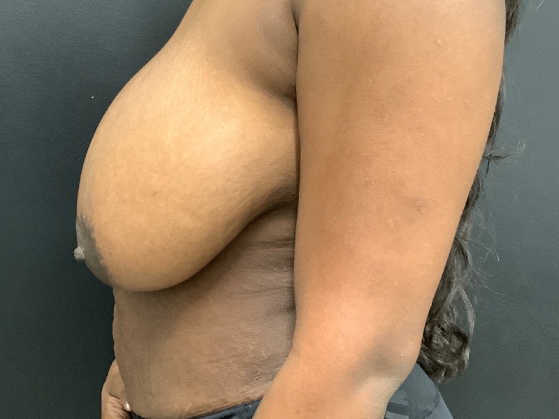 Breast Reduction Before & After Image