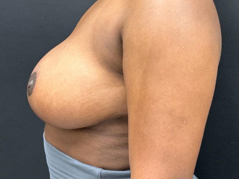 Breast Reduction Before & After Image