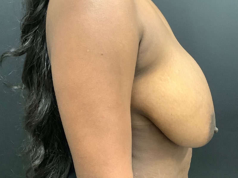Breast Reduction Before & After Image