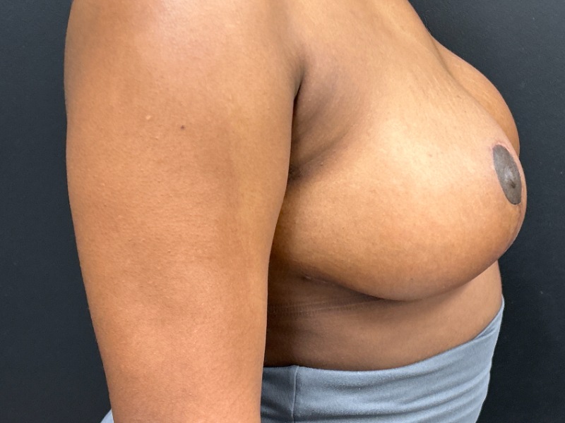 Breast Reduction Before & After Image