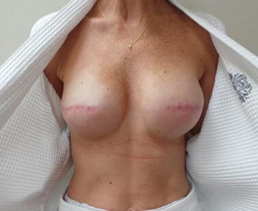 Nipple Reconstruction Before & After Image