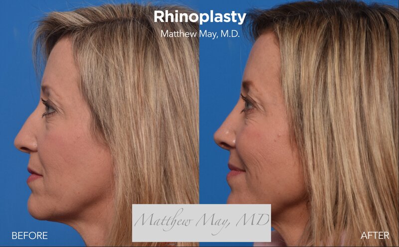 Rhinoplasty Before & After Image