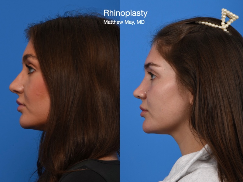 Rhinoplasty Before & After Image