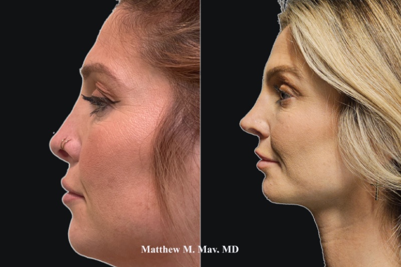 Rhinoplasty Before & After Image
