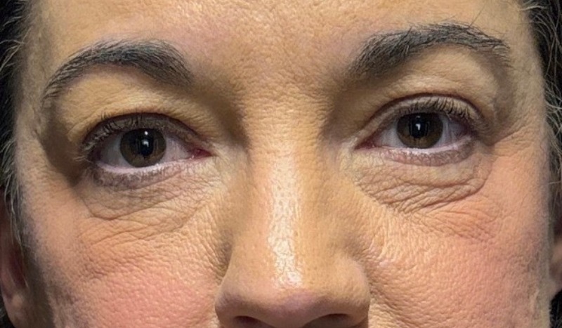 Blepharoplasty Before & After Image