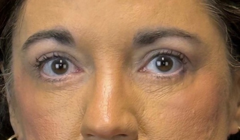 Blepharoplasty Before & After Image