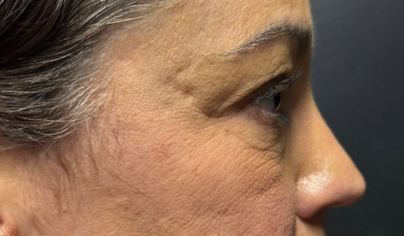 Blepharoplasty Before & After Image