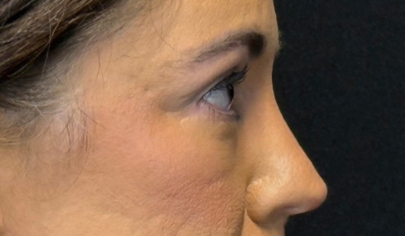 Blepharoplasty Before & After Image