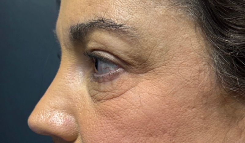 Blepharoplasty Before & After Image