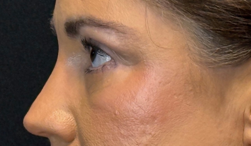 Blepharoplasty Before & After Image