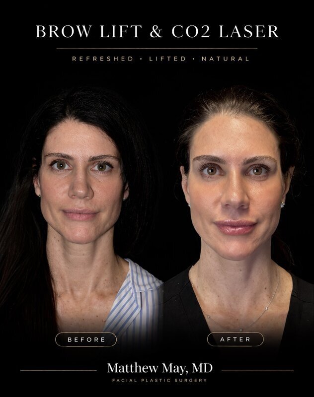 CO2 Laser Before & After Image