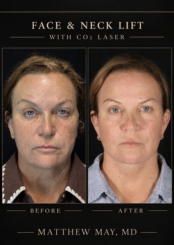 CO2 Laser Before & After Image