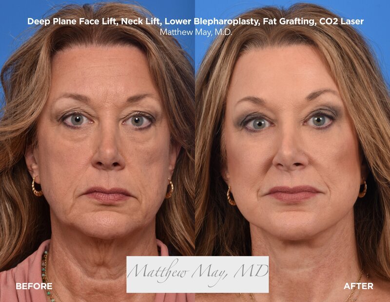 Deep Plane Face & Neck Lift Before & After Image