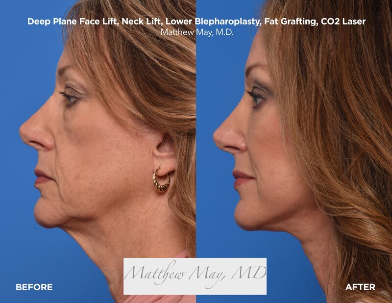 Deep Plane Face & Neck Lift Before & After Image