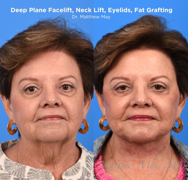 Deep Plane Face & Neck Lift Before & After Image