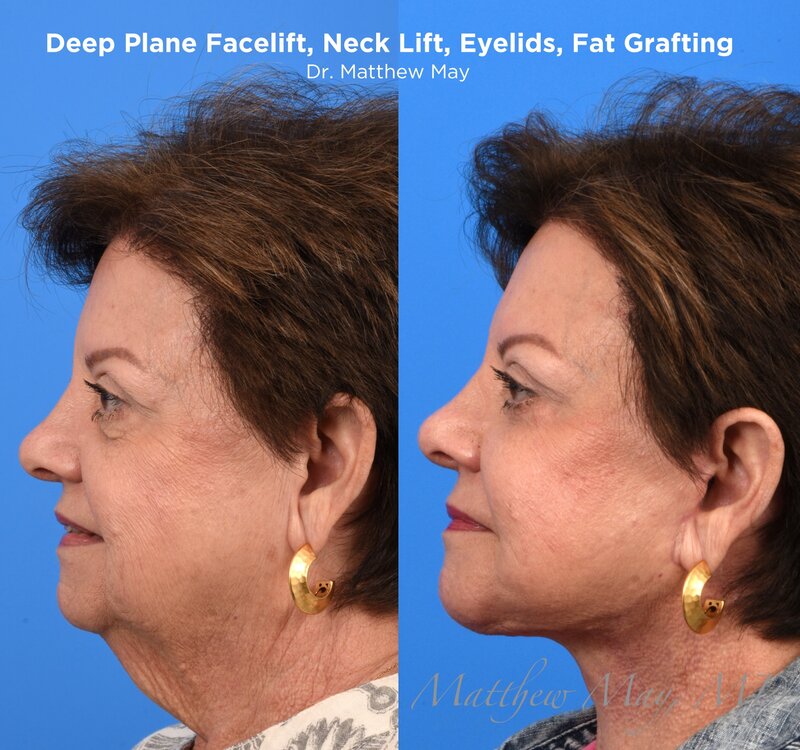 Deep Plane Face & Neck Lift Before & After Image