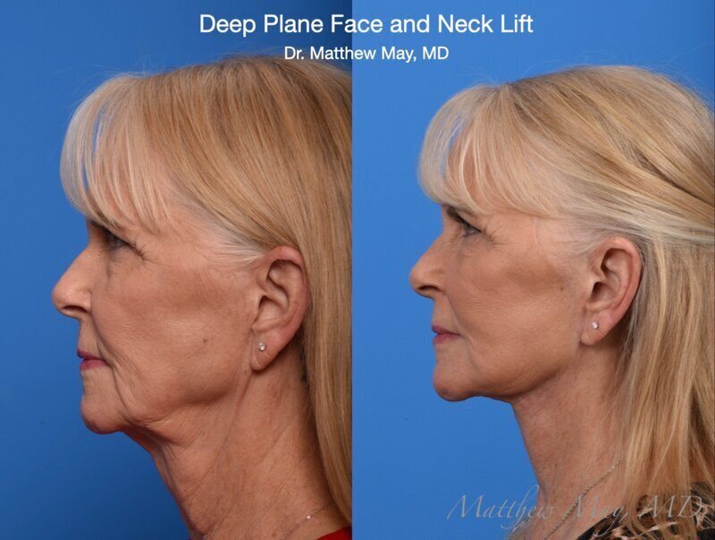 Deep Plane Face & Neck Lift Before & After Image