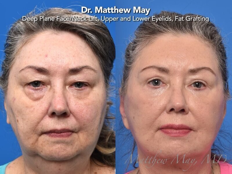 Deep Plane Face & Neck Lift Before & After Image