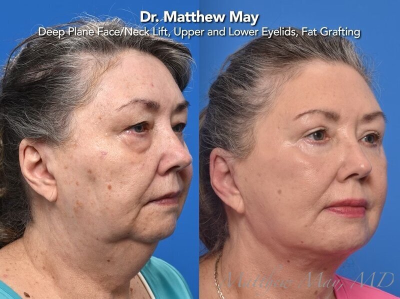Deep Plane Face & Neck Lift Before & After Image