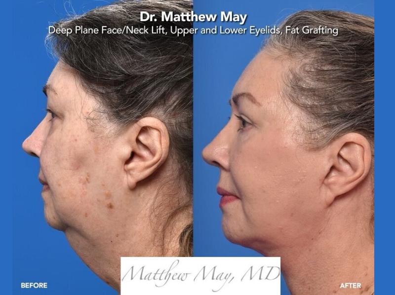 Deep Plane Face & Neck Lift Before & After Image