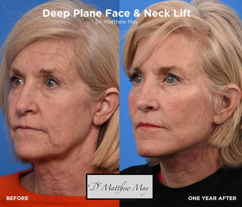 Deep Plane Face & Neck Lift Before & After Image
