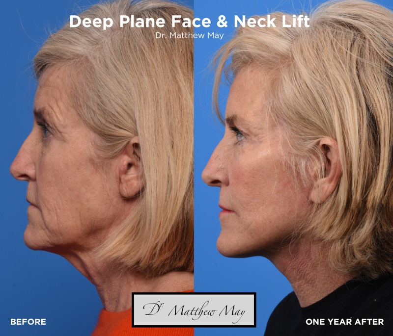 Deep Plane Face & Neck Lift Before & After Image