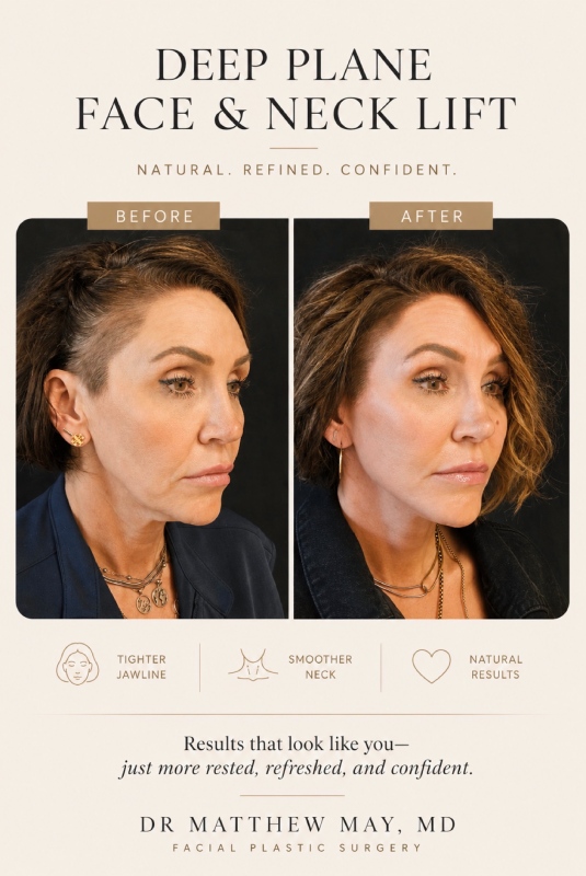 Deep Plane Face & Neck Lift Before & After Image