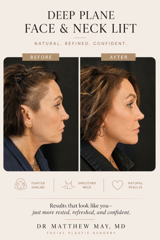 Deep Plane Face & Neck Lift Before & After Image