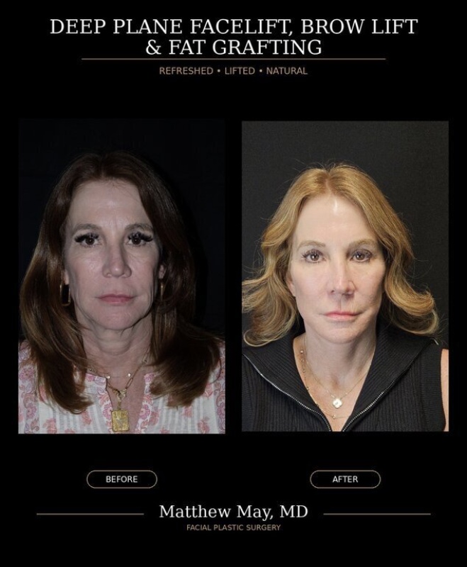 Deep Plane Face & Neck Lift Before & After Image
