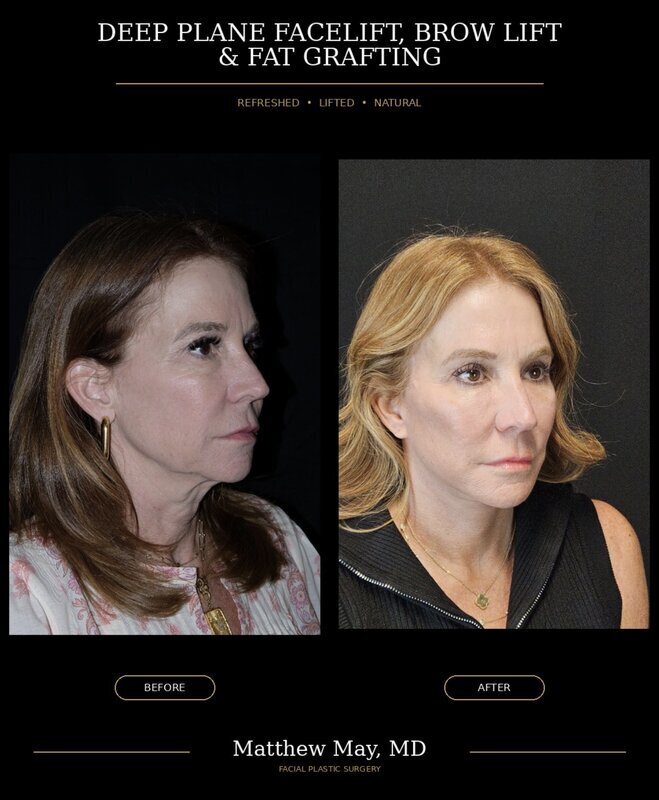 Deep Plane Face & Neck Lift Before & After Image