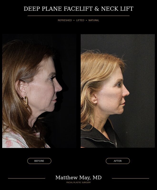 Deep Plane Face & Neck Lift Before & After Image