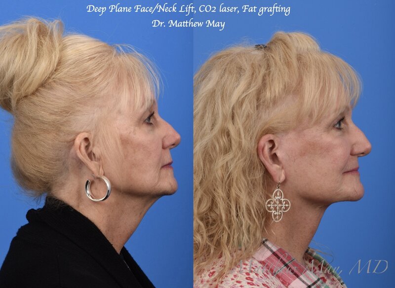 Deep Plane Face & Neck Lift Before & After Image