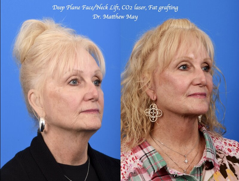 Deep Plane Face & Neck Lift Before & After Image