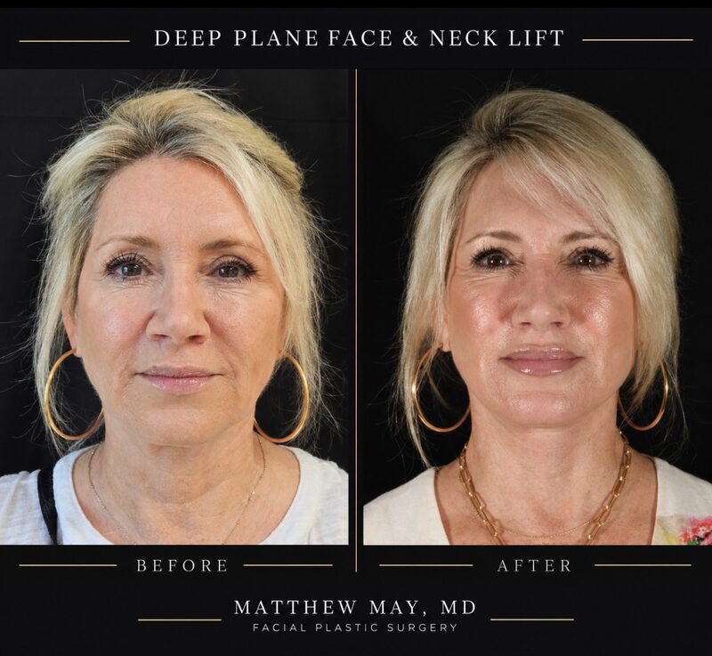 Deep Plane Face & Neck Lift Before & After Image
