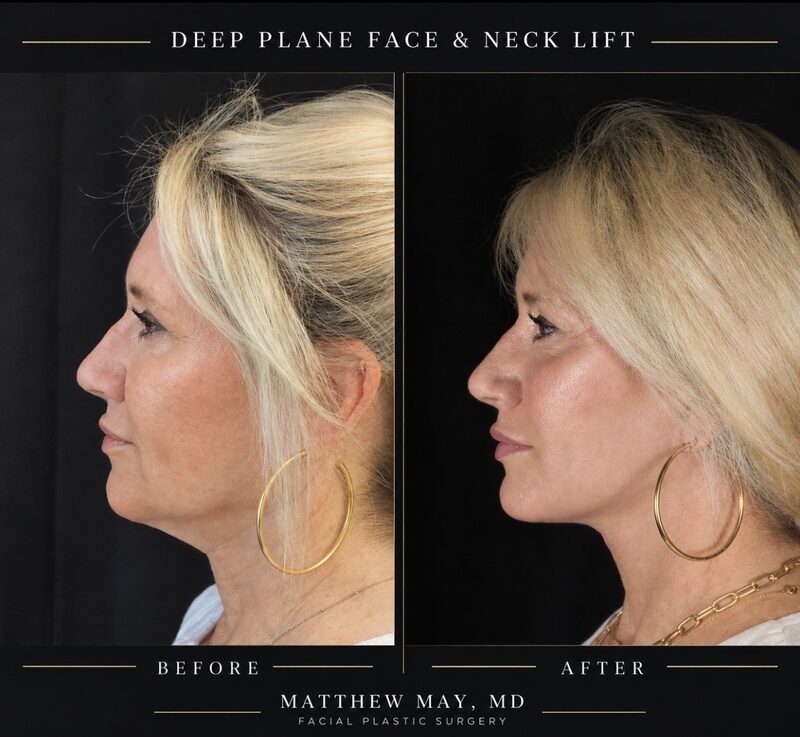 Deep Plane Face & Neck Lift Before & After Image