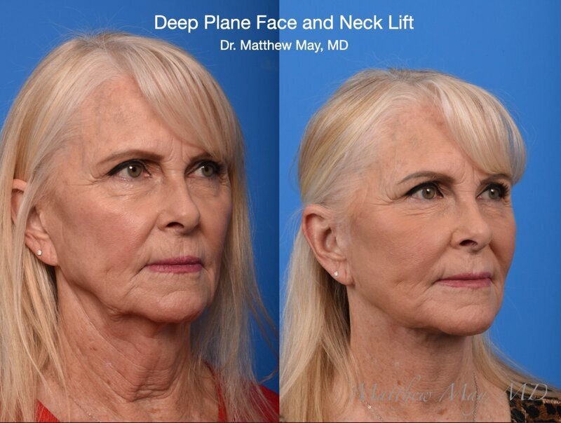 Deep Plane Facelift Before & After Image