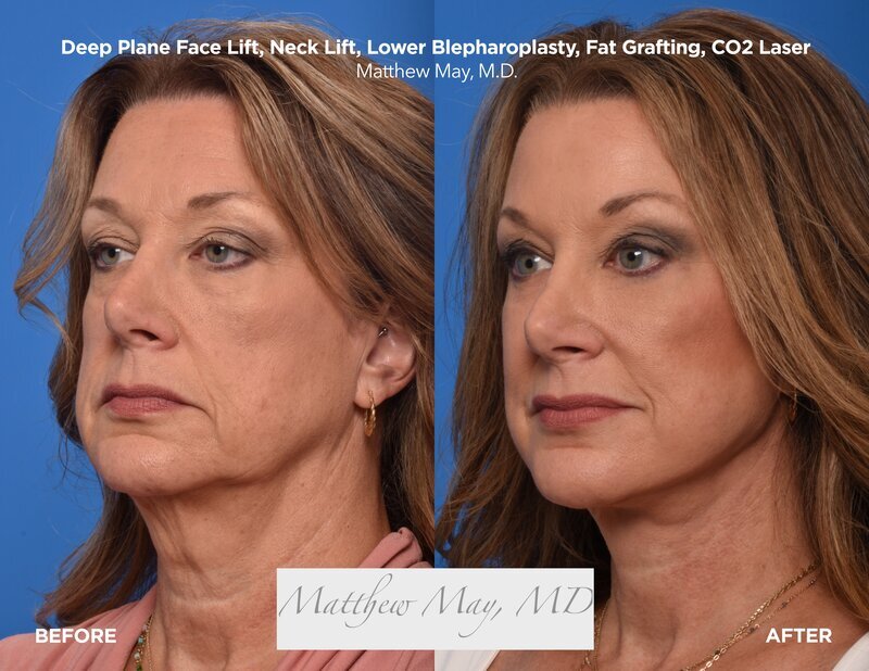 Deep Plane Neck Lift Before & After Image