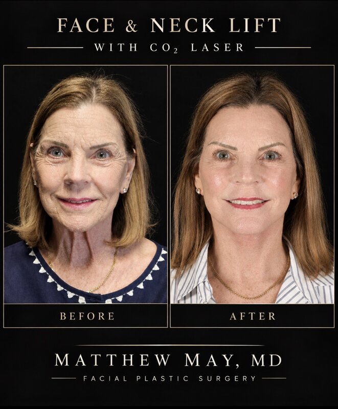 Face & Neck Lift Before & After Image