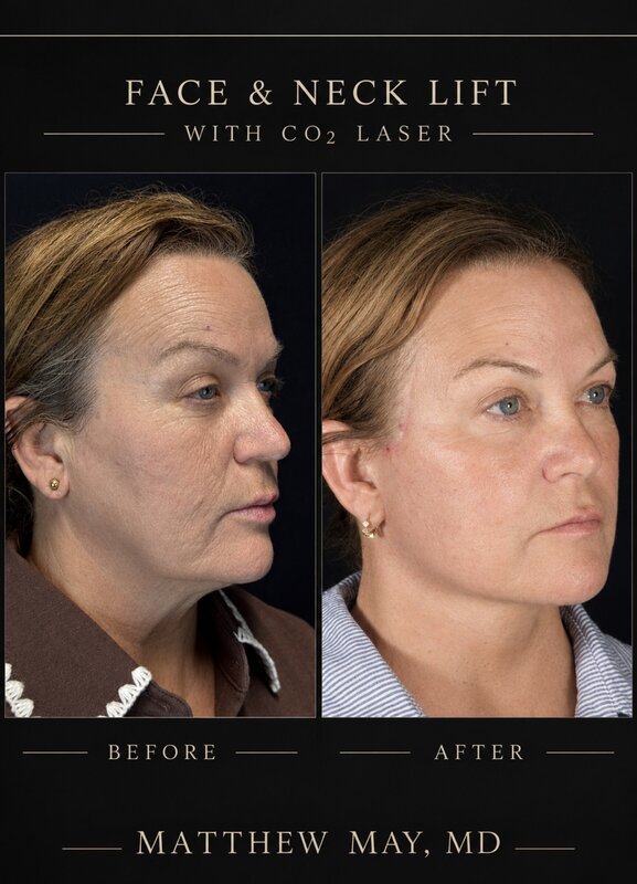 Face & Neck Lift Before & After Image