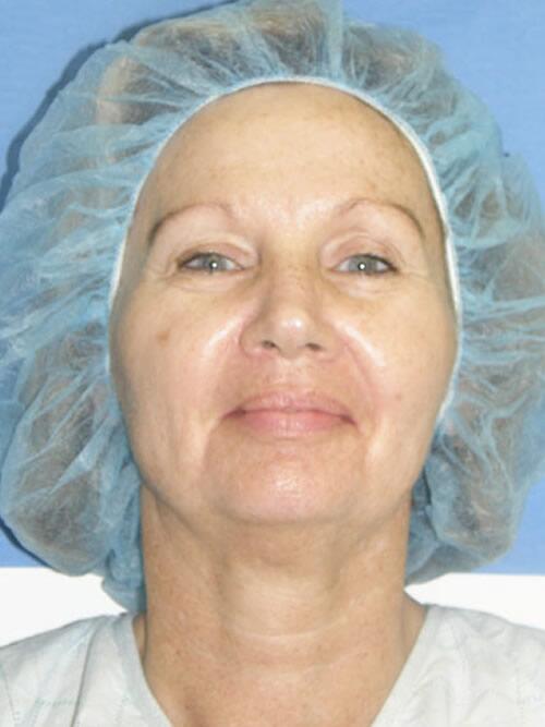 Facelift Before & After Image