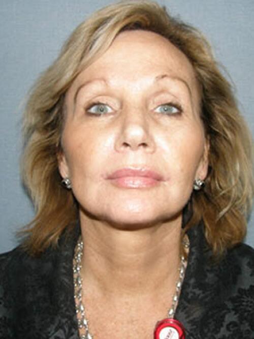 Facelift Before & After Image