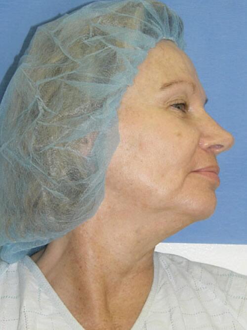 Facelift Before & After Image