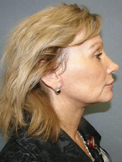 Facelift Before & After Image