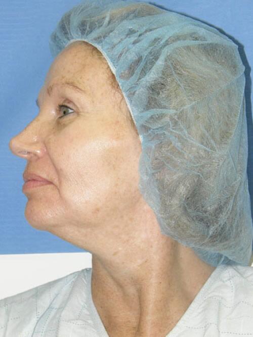 Facelift Before & After Image