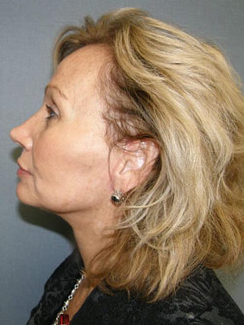 Facelift Before & After Image