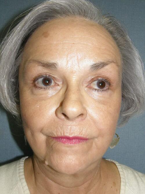 Facelift Before & After Image