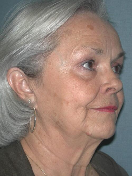 Facelift Before & After Image